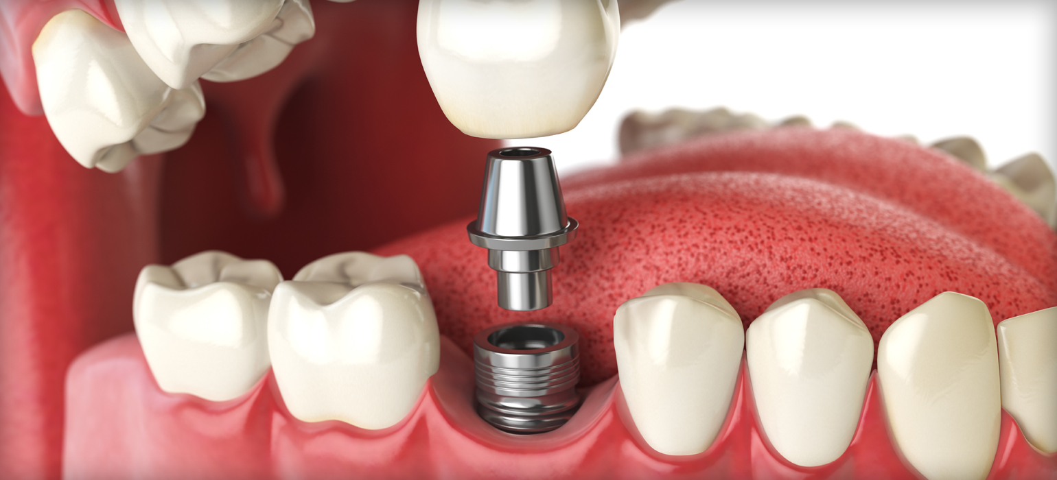 Ourservices Implants